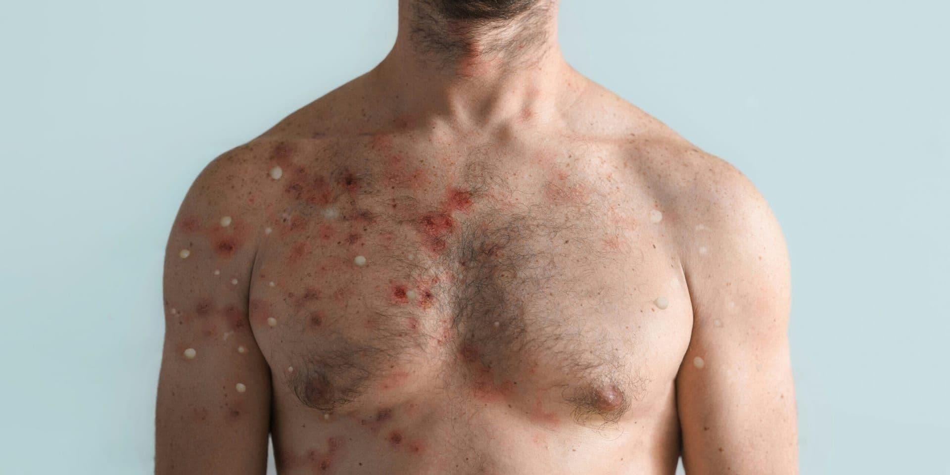Virginia Confirms Second Measles Case of 2025 Amidst National Spike in Infections