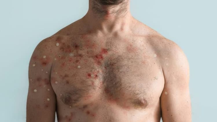Virginia Confirms Second Measles Case of 2025 Amidst National Spike in Infections